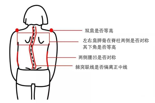 脊柱側彎典型外觀特征
