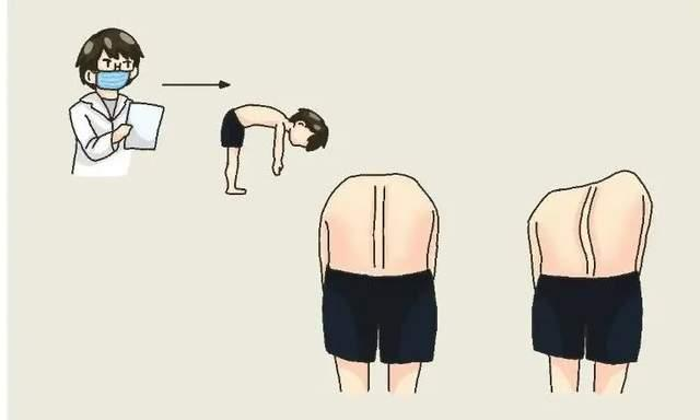 脊柱側彎自查方法