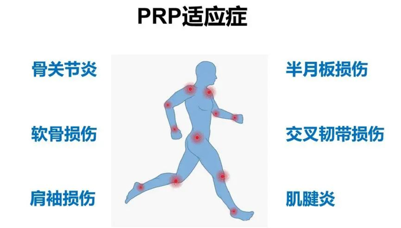 關節prp適應癥